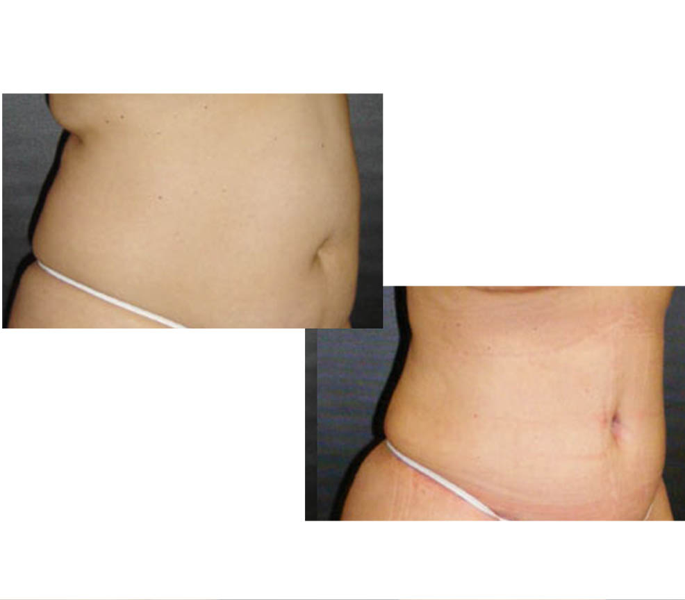 Abdominoplastía