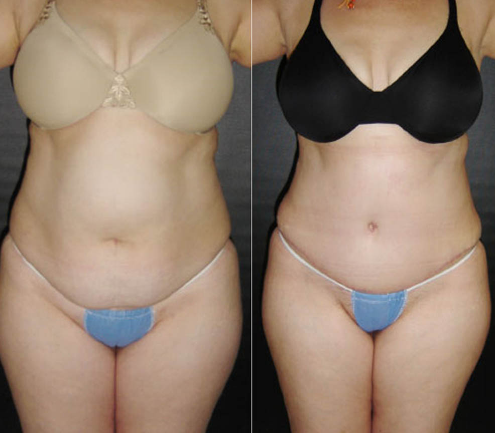 Abdominoplastía
